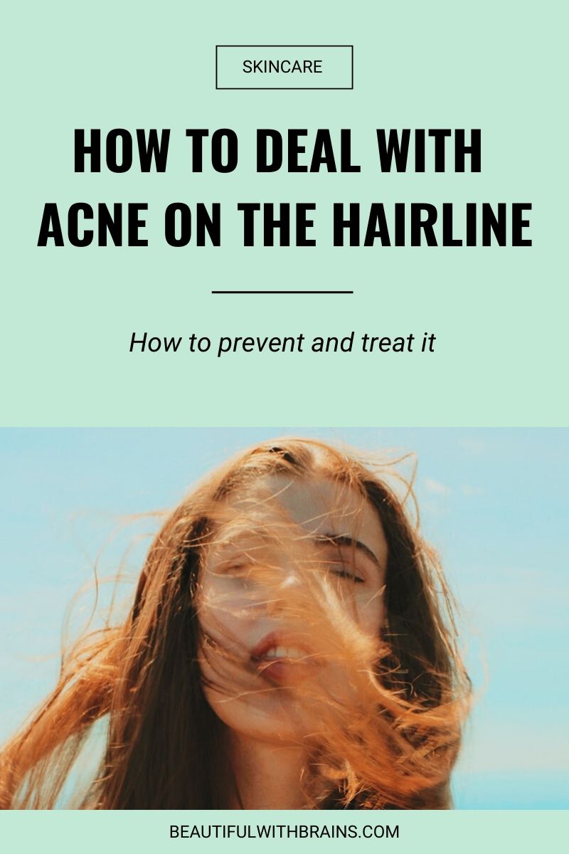 how to deal with acne on the hairline