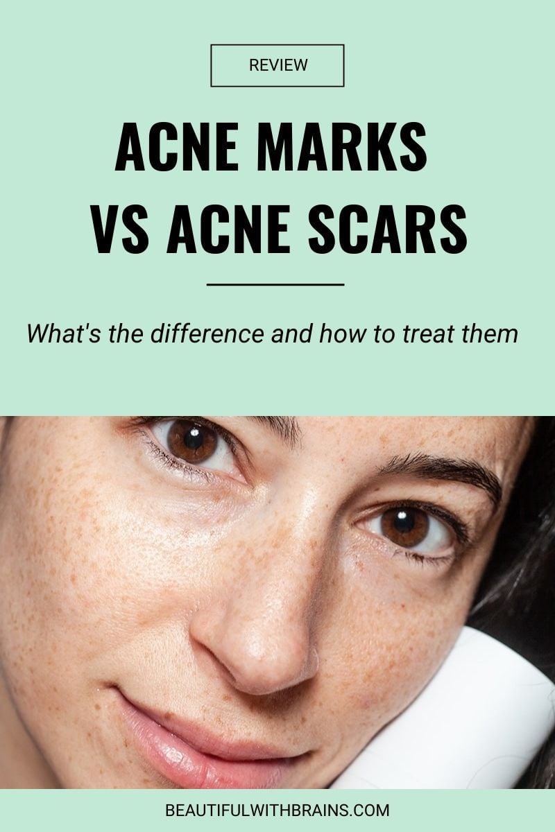 difference between acne marks and acne scars